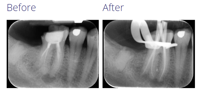 Before and after X-rays of a failing root canal treatment that was retreated