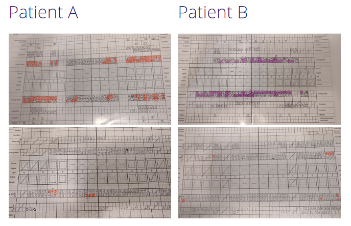 Periodontal charts for two patients before and after gum disease treatment