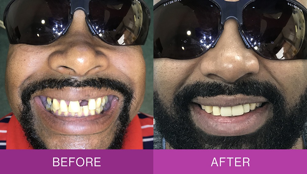 Before and after ceramic bridge treatment, case 1