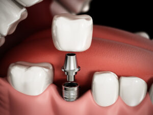 Illustration of a dental implant post, abutment and crown replacing a missing tooth