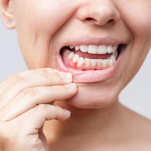 Woman pulling down her lip to show red, inflamed gums