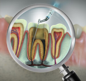 Illustration of root canal treatment inside a tooth, under a magnifying glass
