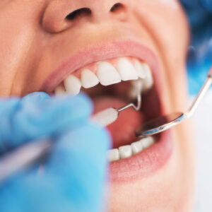 Close-up of a dental mirror and probe during a hygiene check