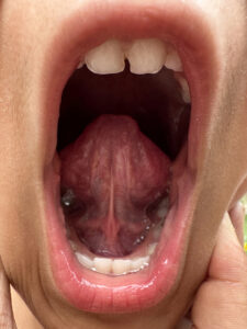 Open mouth showing a tongue-tie under the tongue