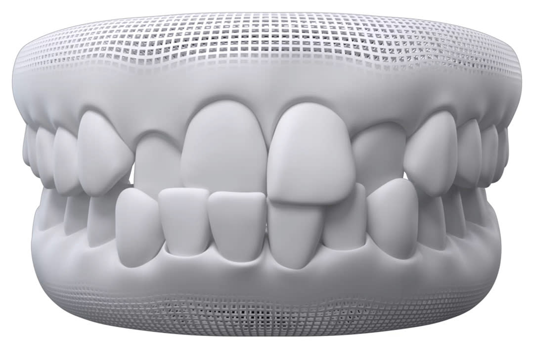 Invisalign timelapse: crossbite