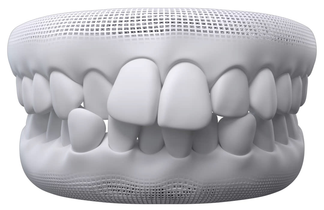 Invisalign timelapse: crowded teeth