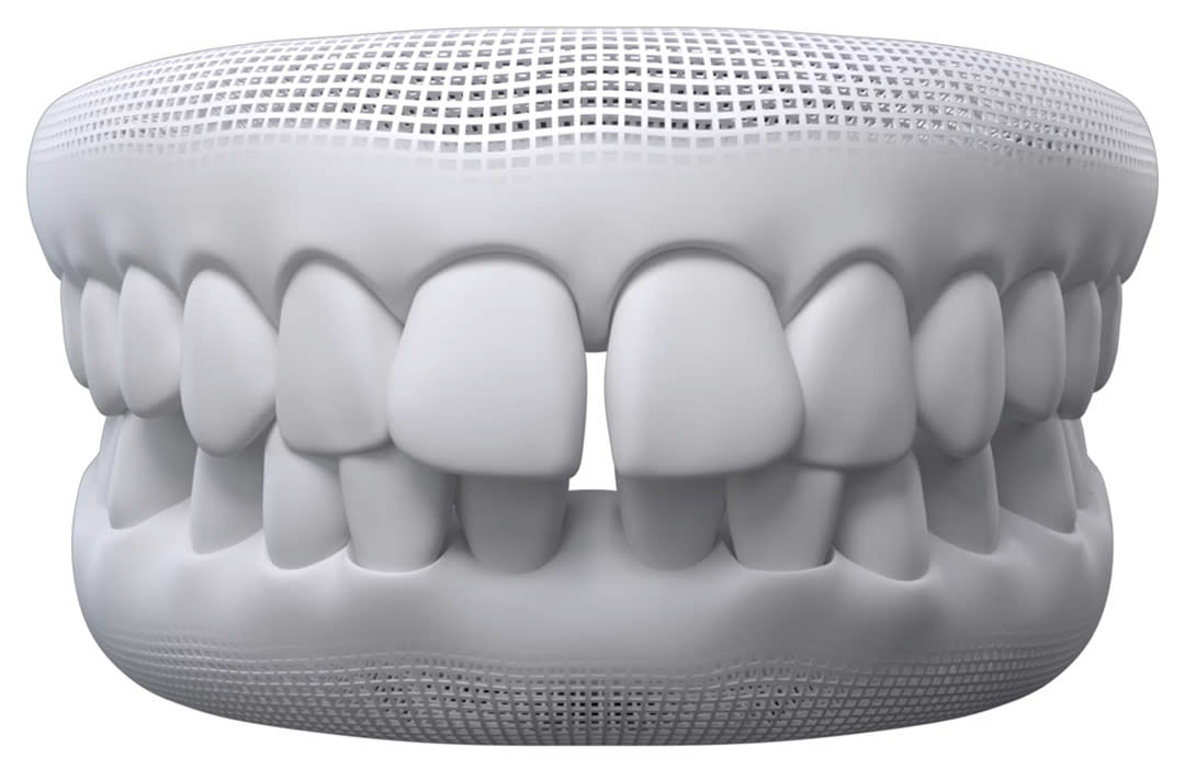 Invisalign timelapse: gaps between teeth