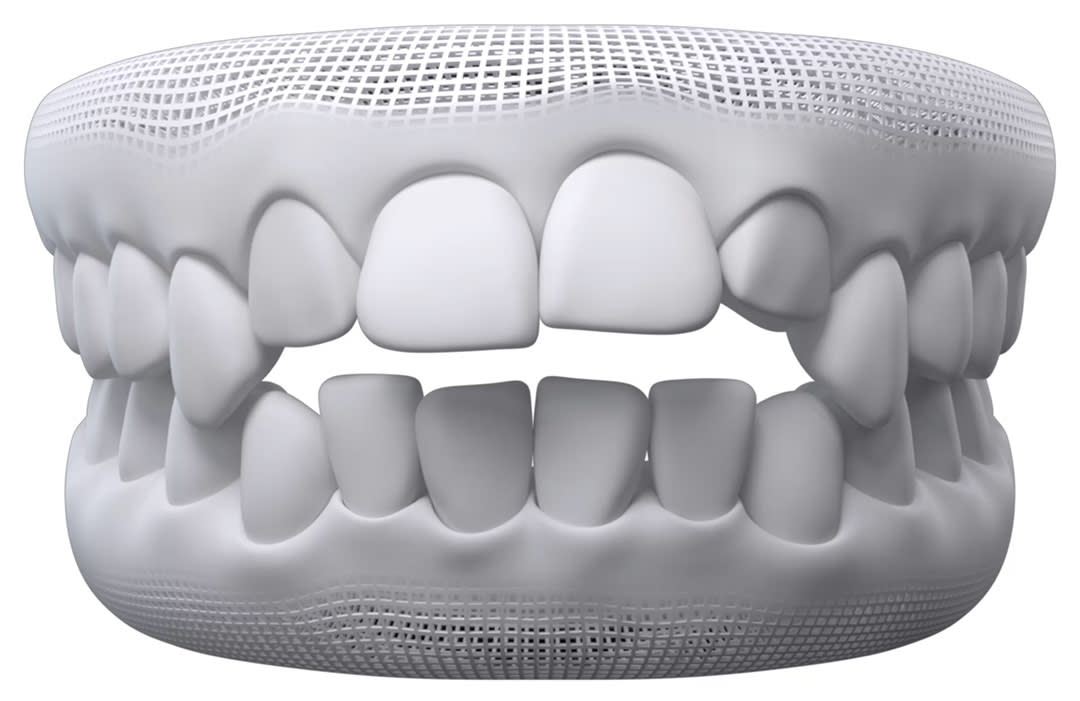 Invisalign timelapse: open bite