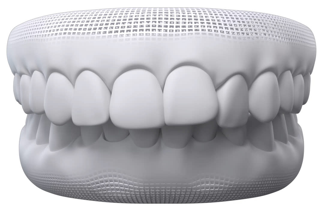 Invisalign timelapse: overbite