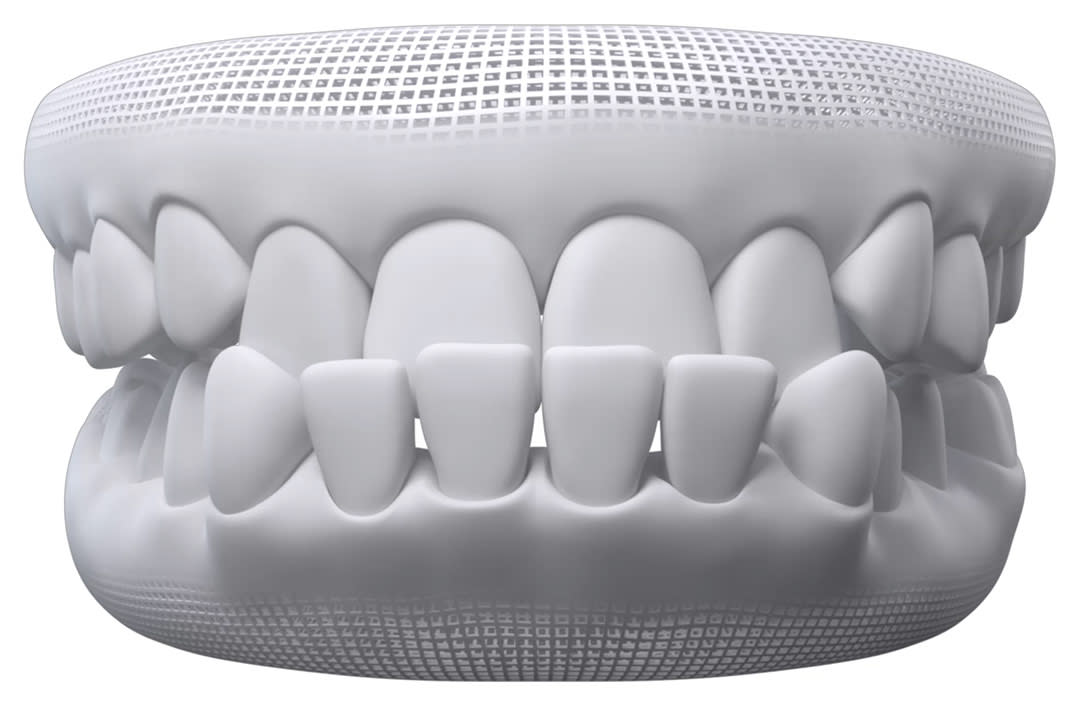 Invisalign timelapse: underbite
