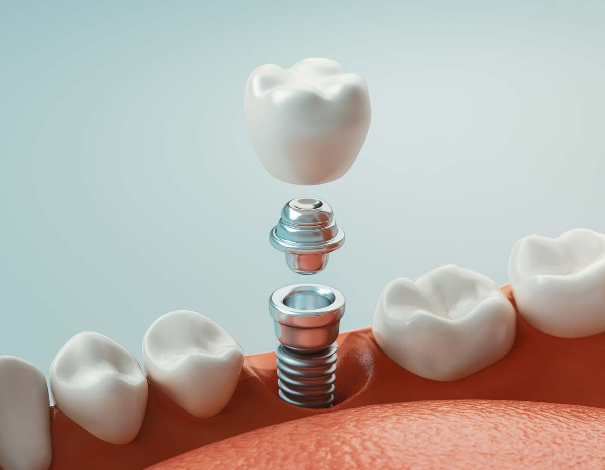 Illustration of a dental implant being assembled, with the crown and abutment lowering onto a titanium post in the gum